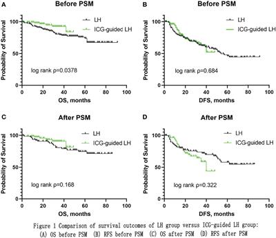 Indocyanine green fluorescence-guided laparoscopic hepatectomy versus conventional laparoscopic hepatectomy for hepatocellular carcinoma: A single-center propensity score matching study